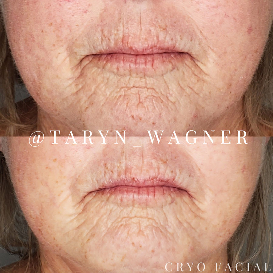 Cryo Facial Services by Taryn Wagner in Lodi, CA